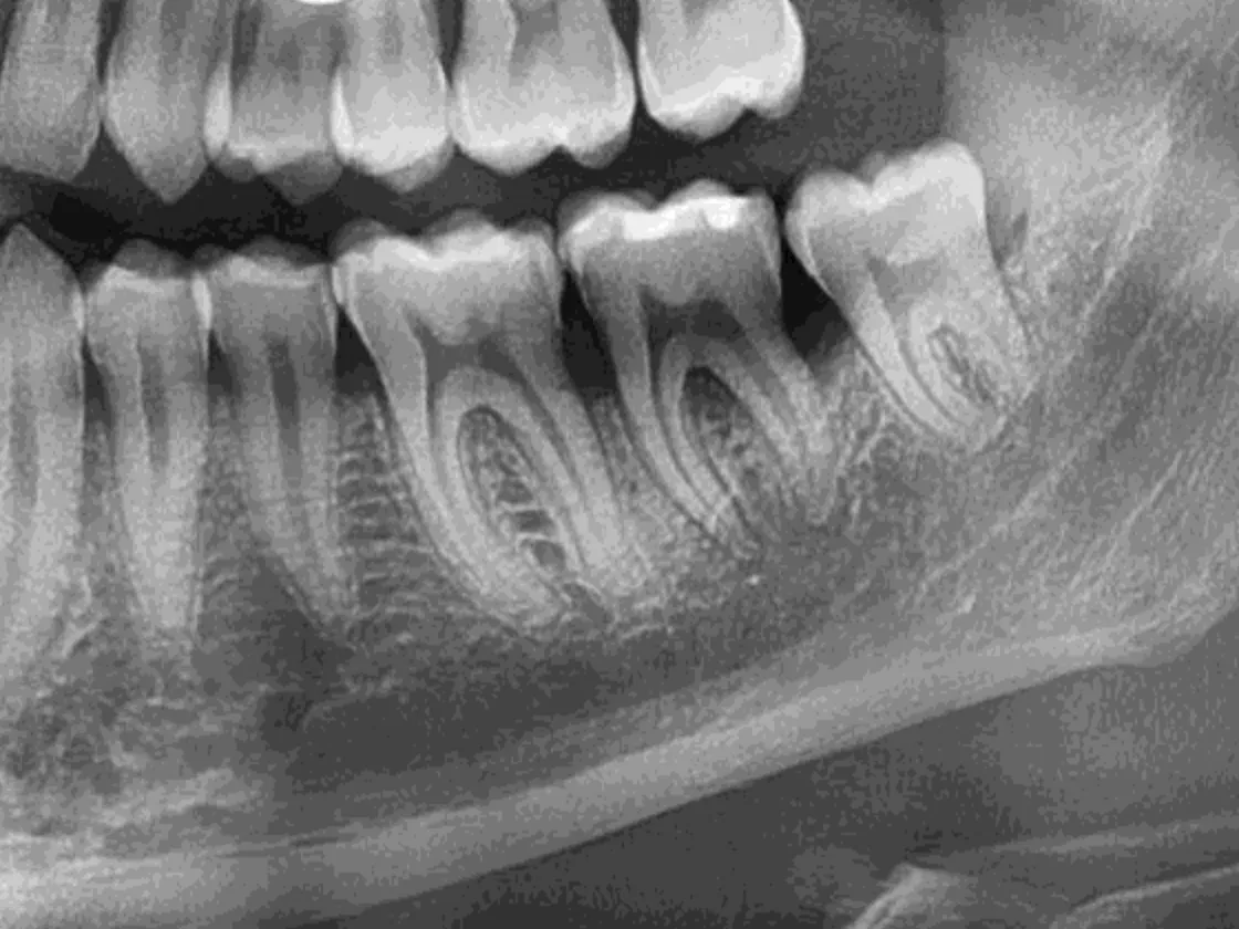 Root apices, periodontal ligament space and trabecular bone resolved on a VATECH panoramic