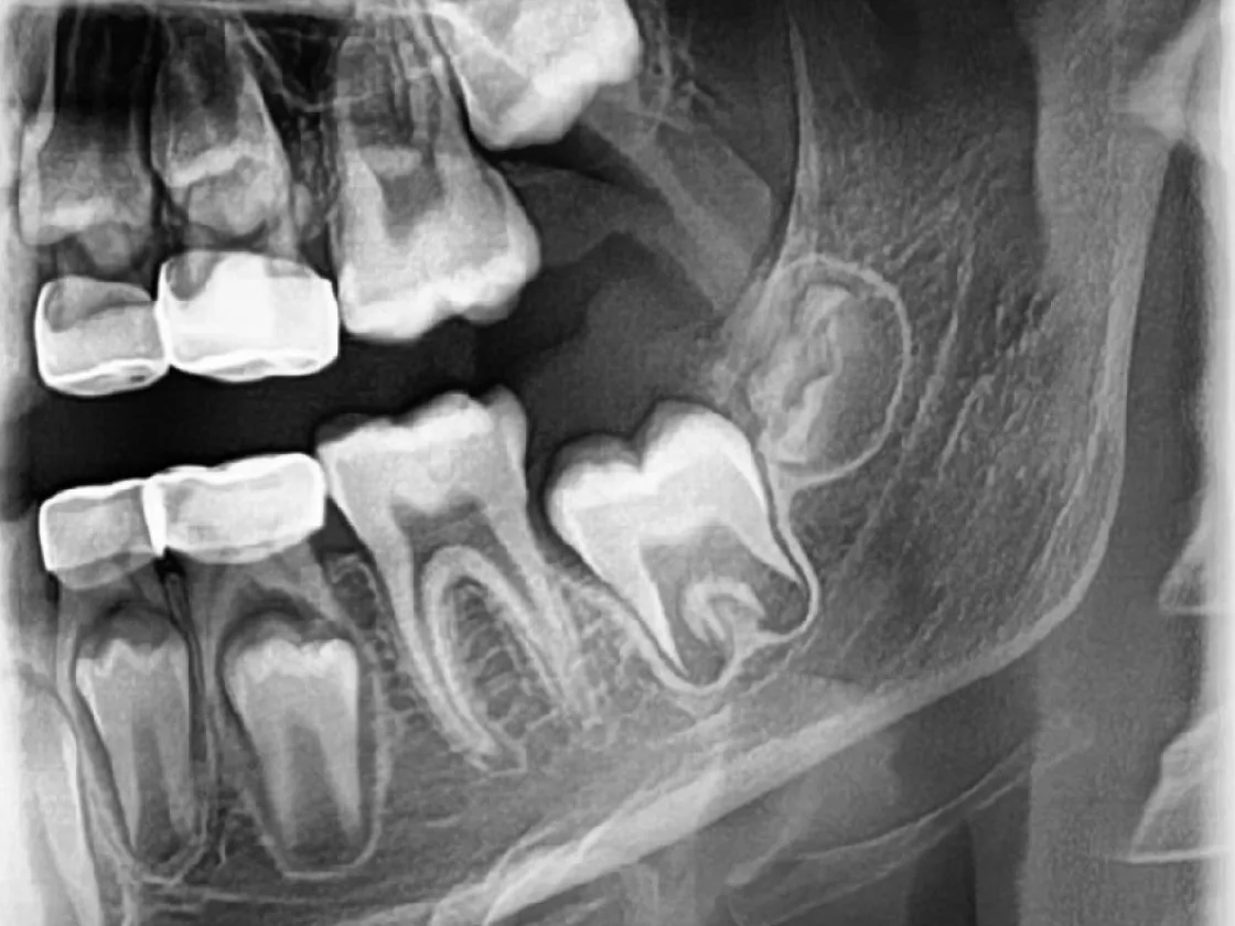 Enamel, dentine, pulp chamber and surrounding bone separating clearly on a VATECH radiograph