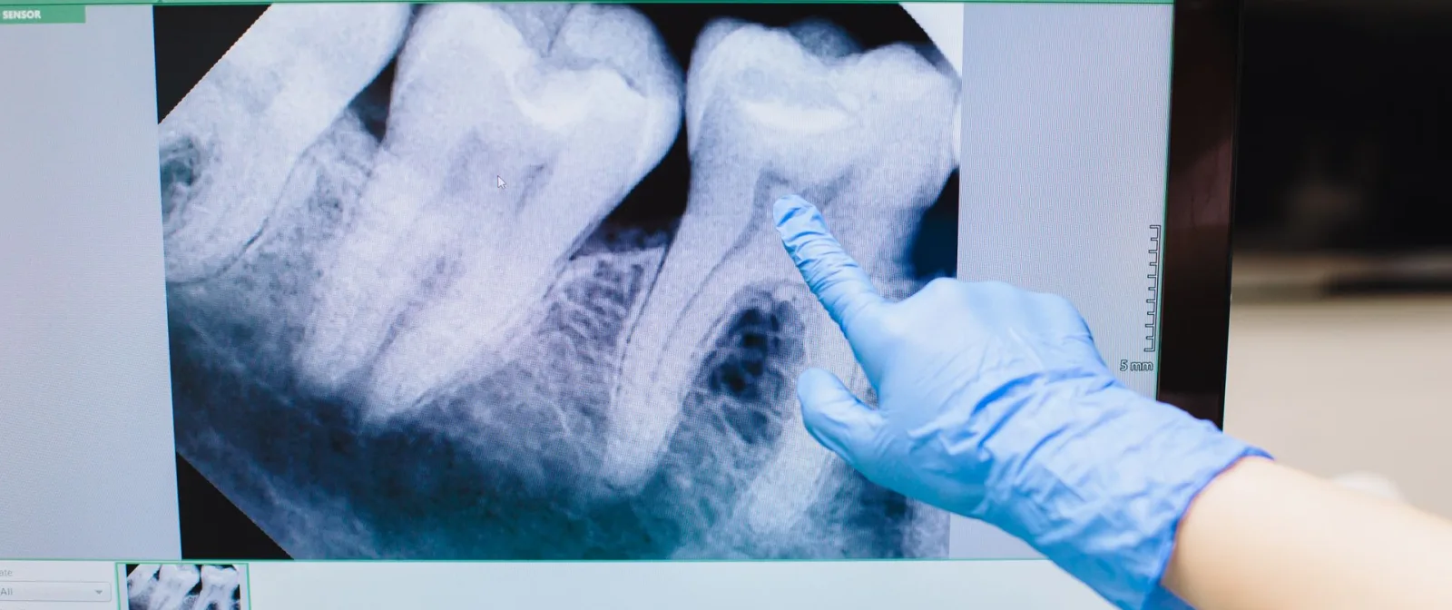A dental radiograph open on a chairside monitor, moments after the exposure
