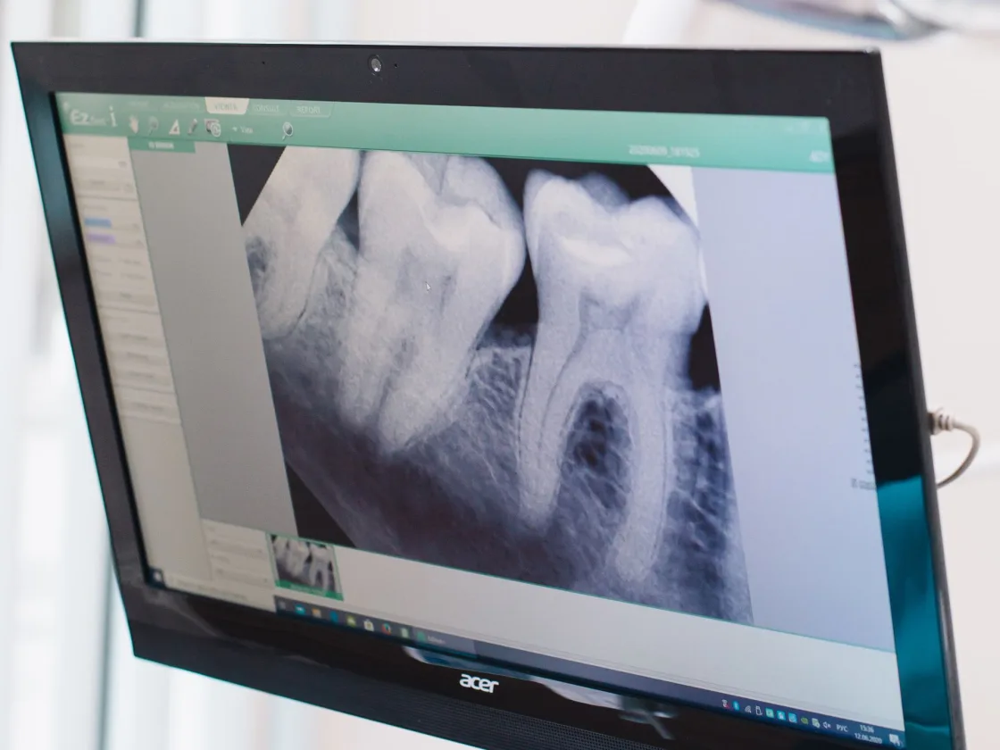 A monitor beside the dental chair showing the radiograph just taken
